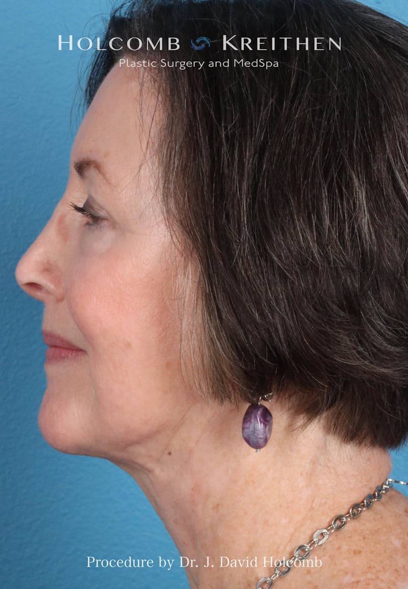Facelift Before & After Gallery - Patient 188566 - Image 6