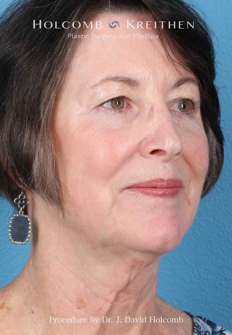 Facelift Before & After Gallery - Patient 188566 - Image 7