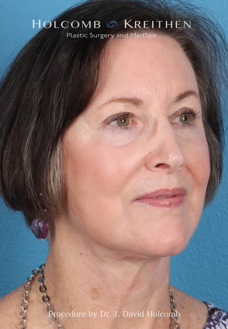 Facelift Before & After Gallery - Patient 188566 - Image 8