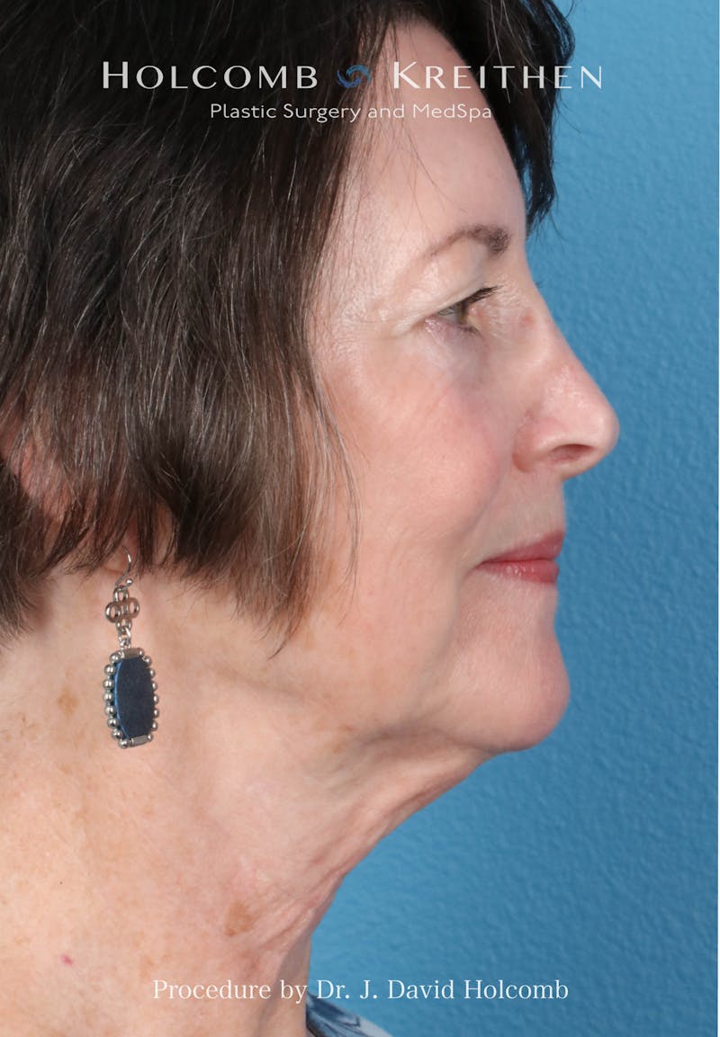 Facelift Before & After Gallery - Patient 188566 - Image 9