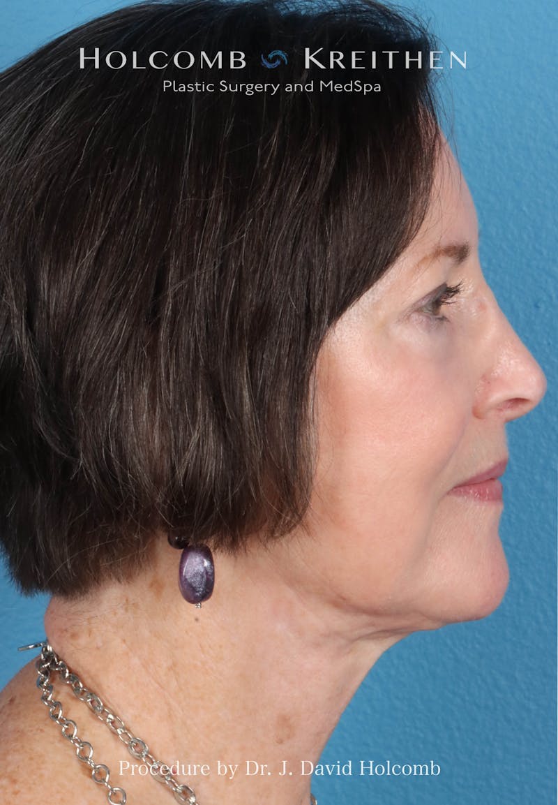 Facelift Before & After Gallery - Patient 188566 - Image 10