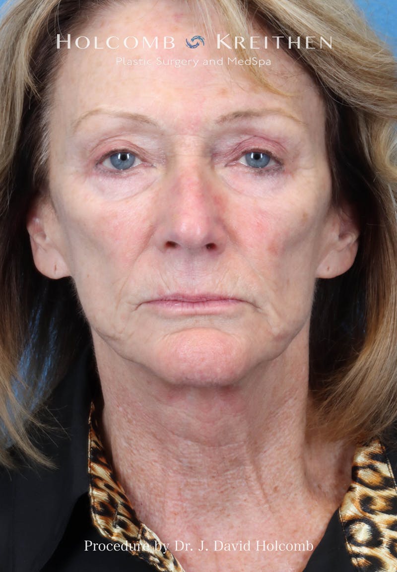 Facial Implants Before & After Gallery - Patient 283772 - Image 1