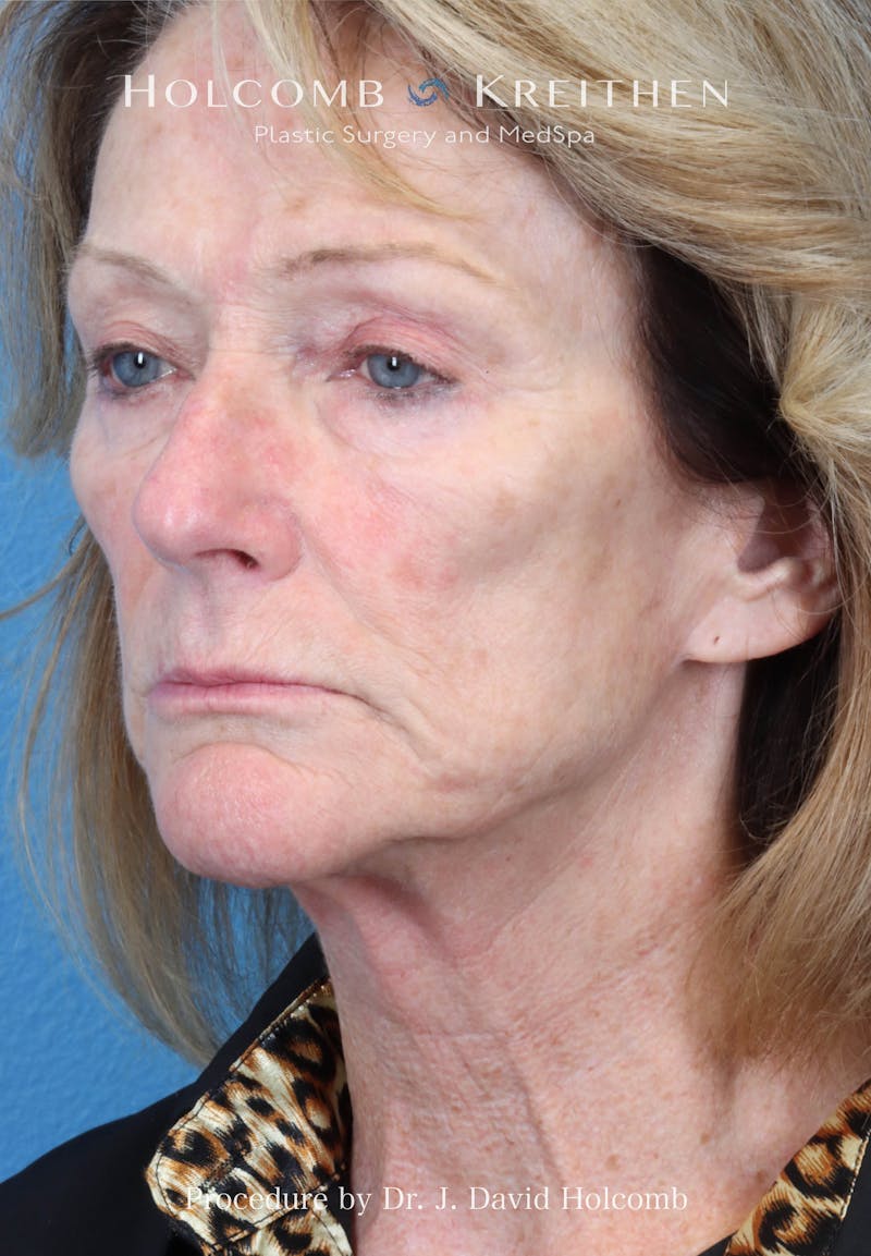 Facial Implants Before & After Gallery - Patient 283772 - Image 3