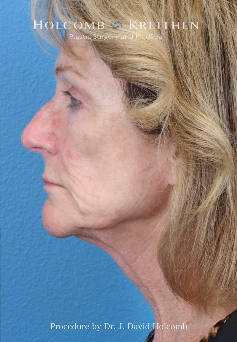 Facial Implants Before & After Gallery - Patient 283772 - Image 5