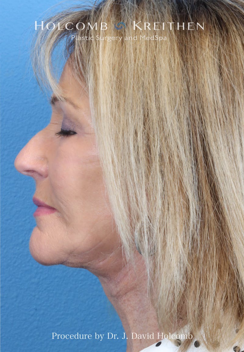 Facial Implants Before & After Gallery - Patient 283772 - Image 6