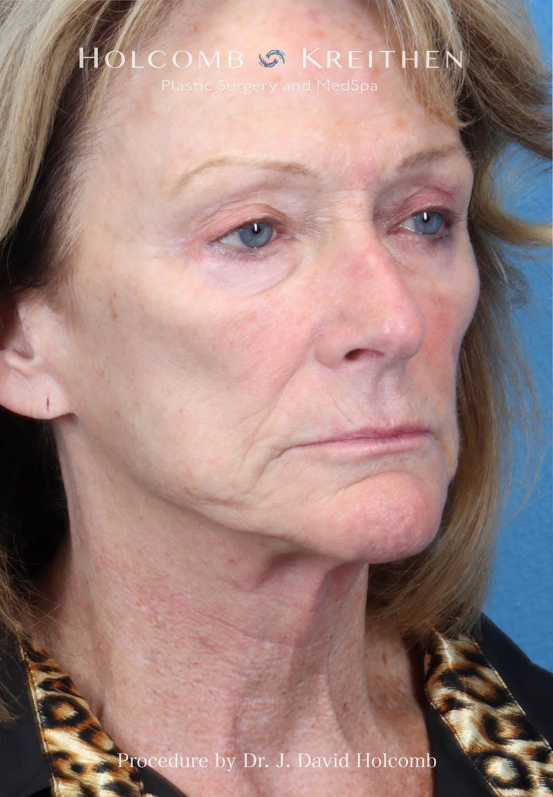 Facial Implants Before & After Gallery - Patient 283772 - Image 7