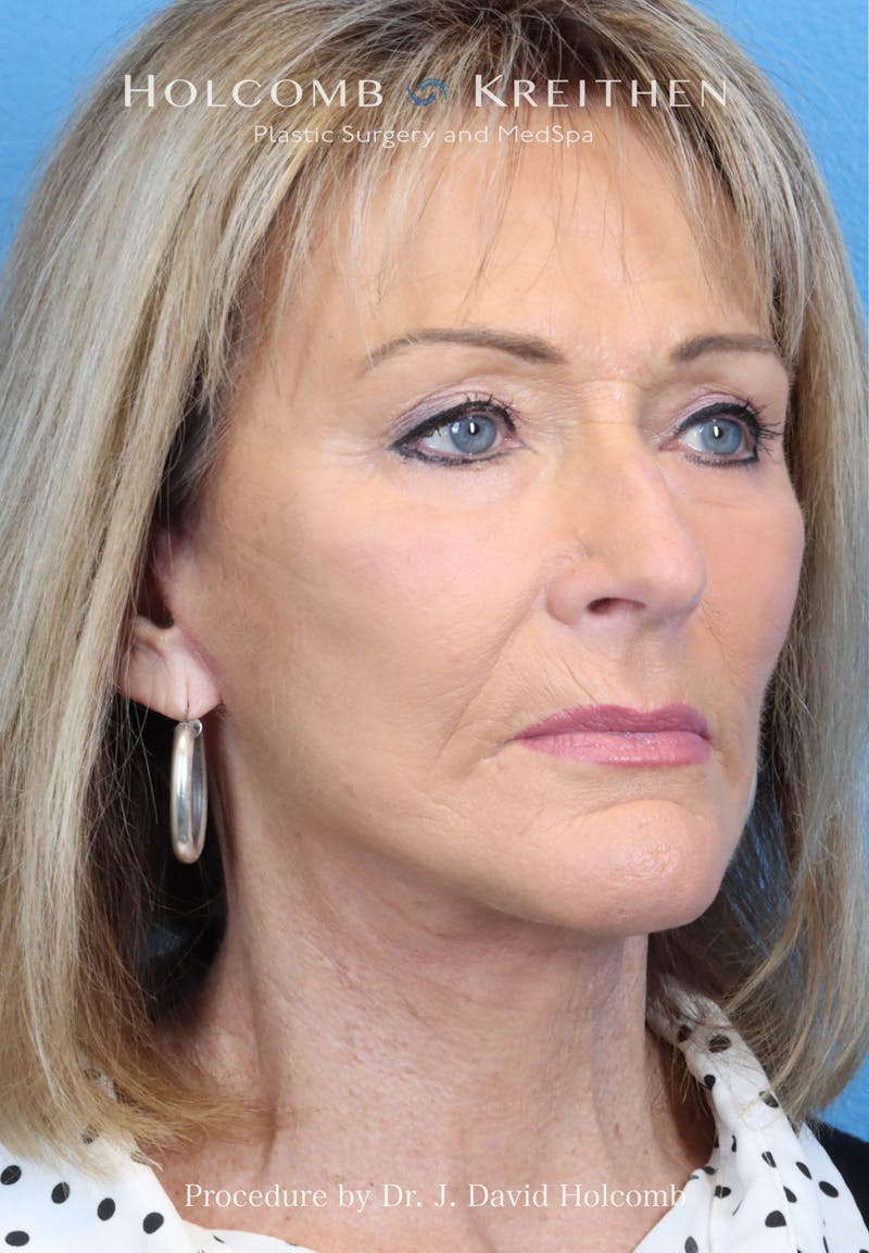 Facial Implants Before & After Gallery - Patient 283772 - Image 8