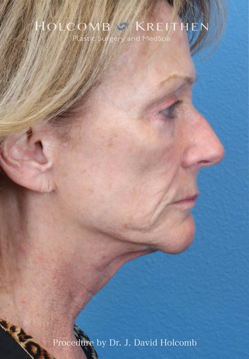Facial Implants Before & After Gallery - Patient 283772 - Image 9