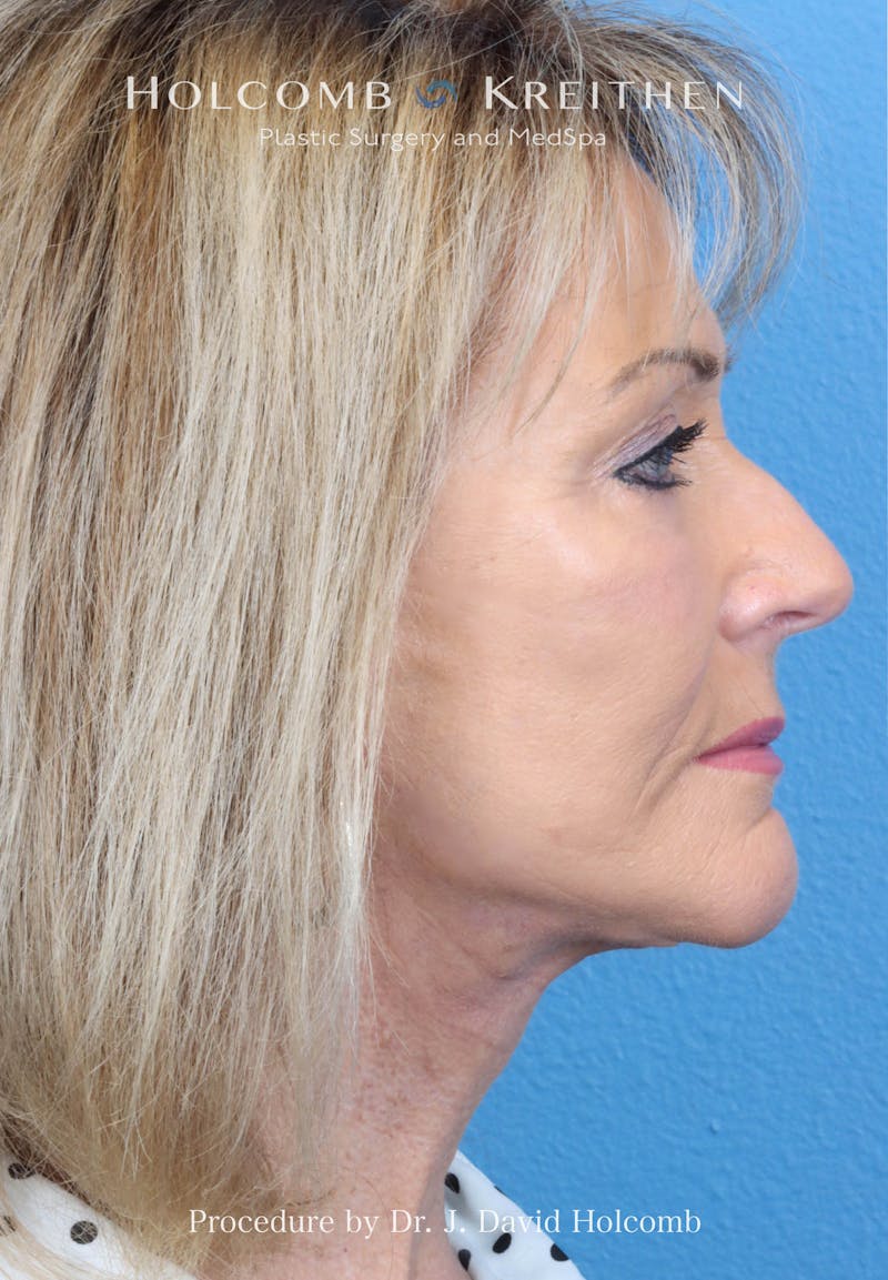 Facial Implants Before & After Gallery - Patient 283772 - Image 10