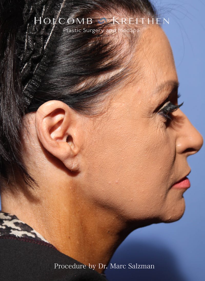 Facelift Before & After Gallery - Patient 427829 - Image 1