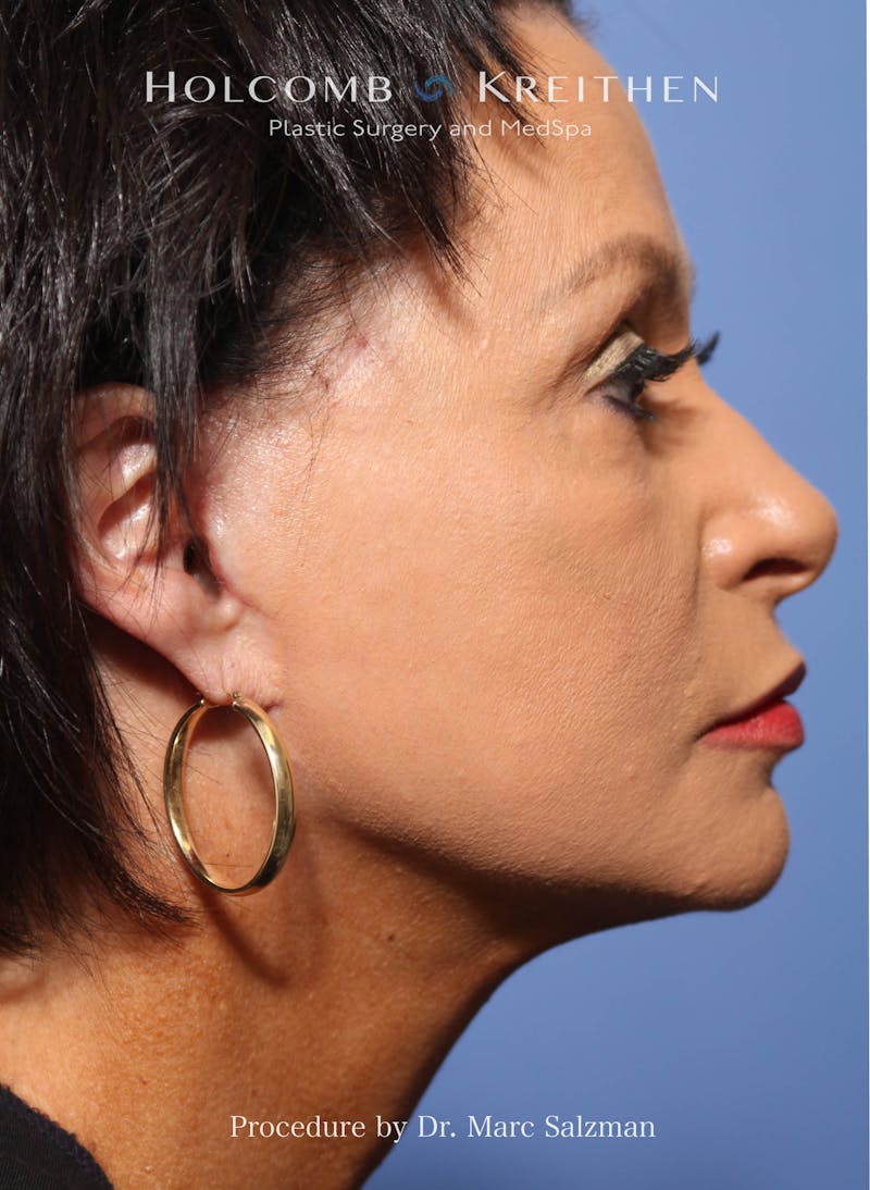 Facelift Before & After Gallery - Patient 427829 - Image 2