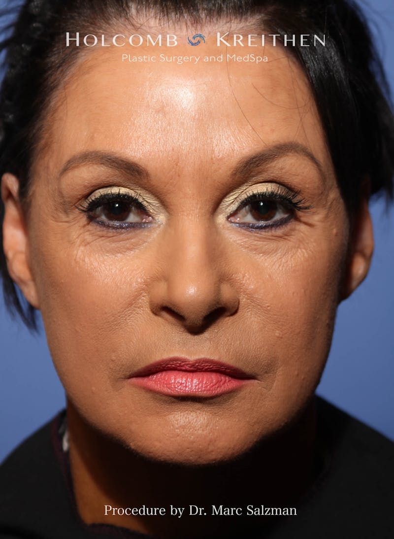 Facelift Before & After Gallery - Patient 427829 - Image 3