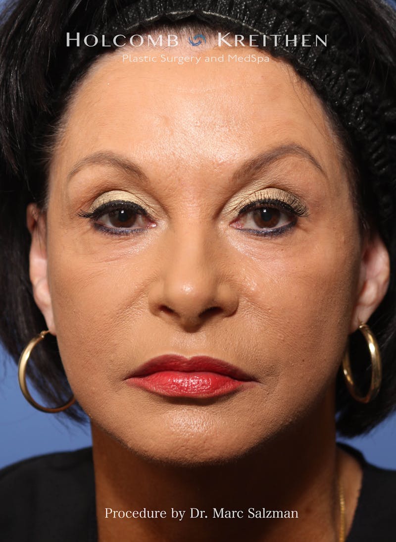 Facelift Before & After Gallery - Patient 427829 - Image 4