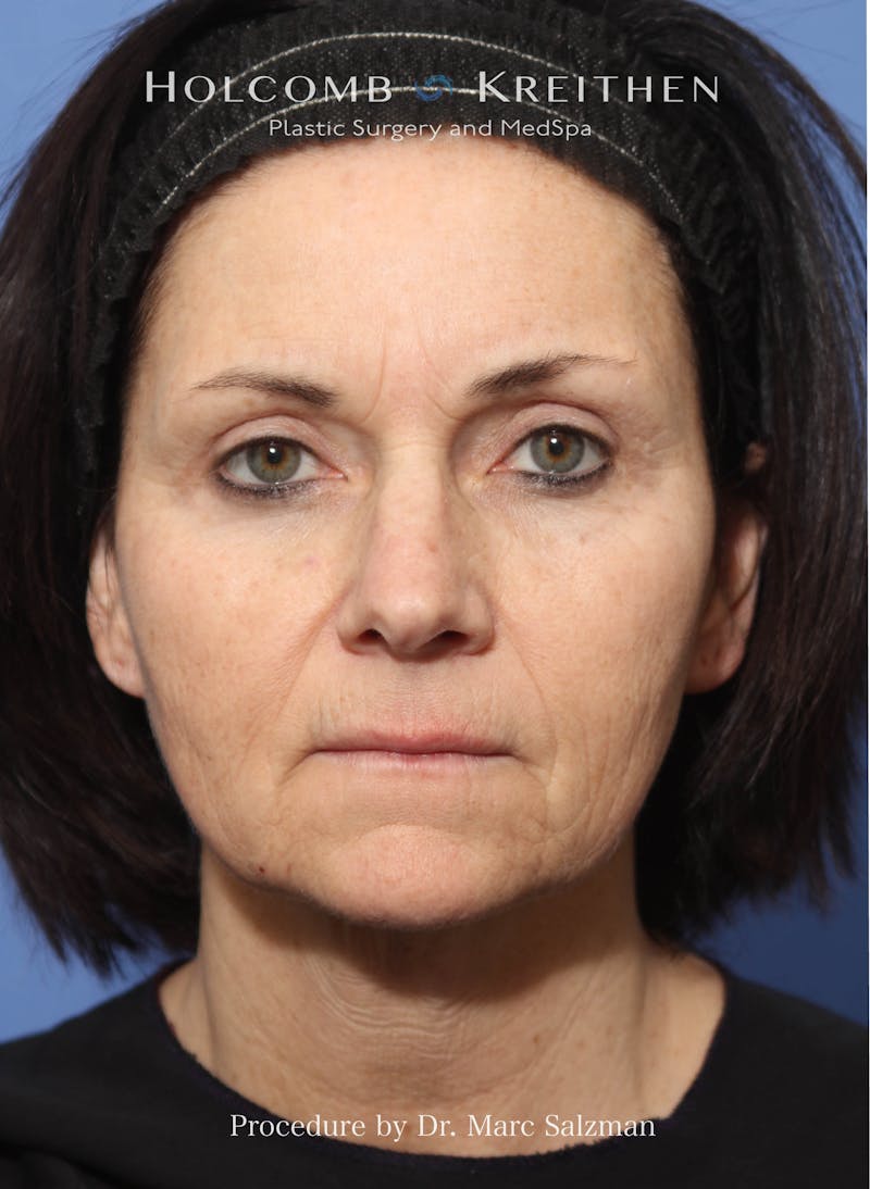 Facelift Before & After Gallery - Patient 111441 - Image 1