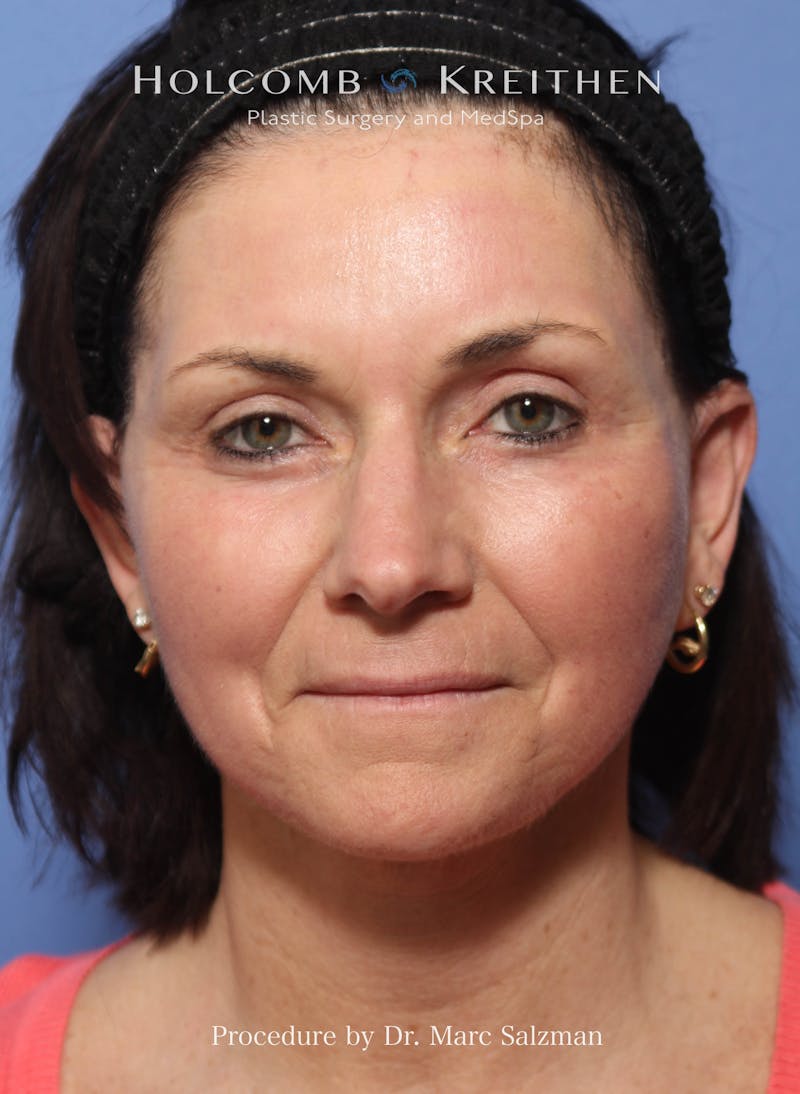 Facelift Before & After Gallery - Patient 111441 - Image 2
