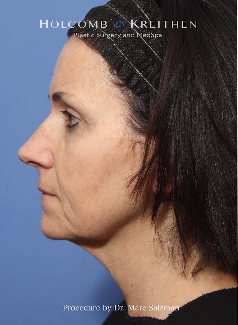 Facelift Before & After Gallery - Patient 111441 - Image 3