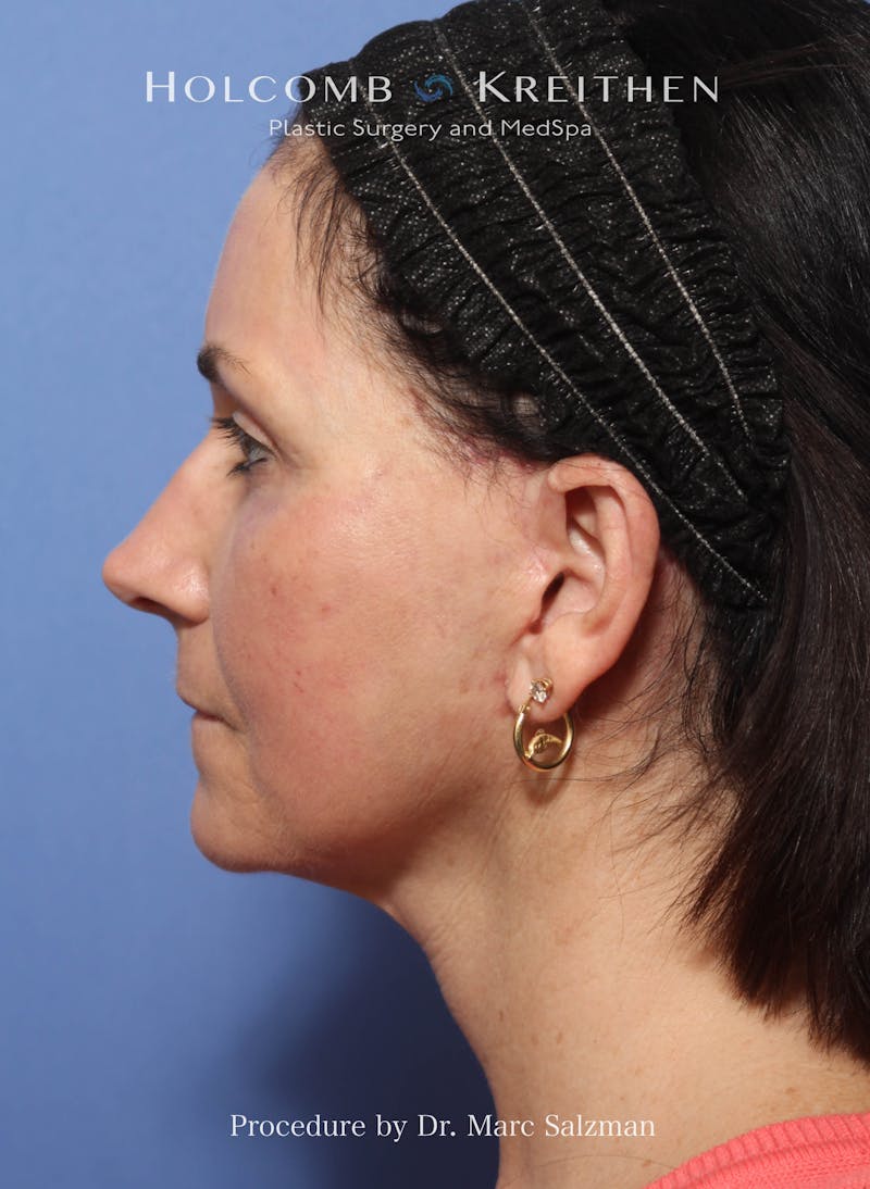 Facelift Before & After Gallery - Patient 111441 - Image 4
