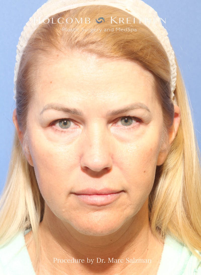 Facelift Before & After Gallery - Patient 354258 - Image 1