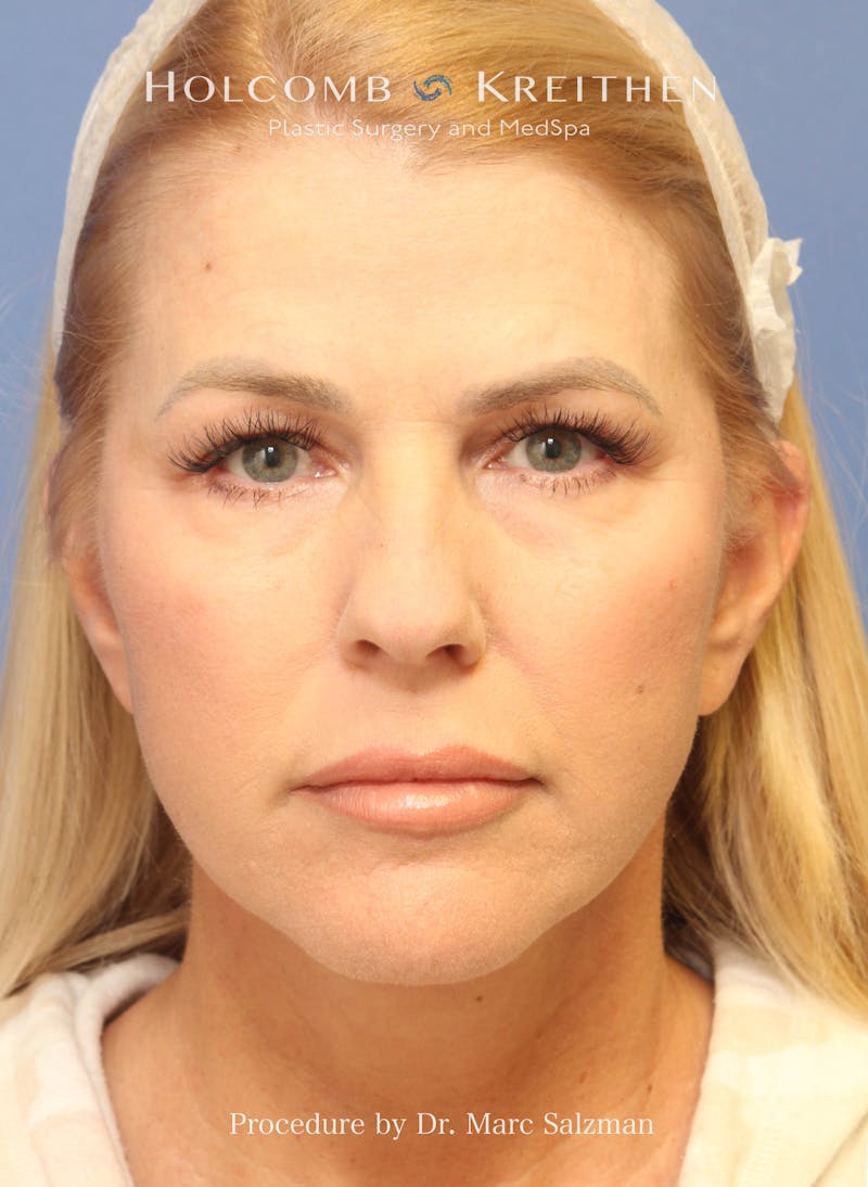 Facelift Before & After Gallery - Patient 354258 - Image 2