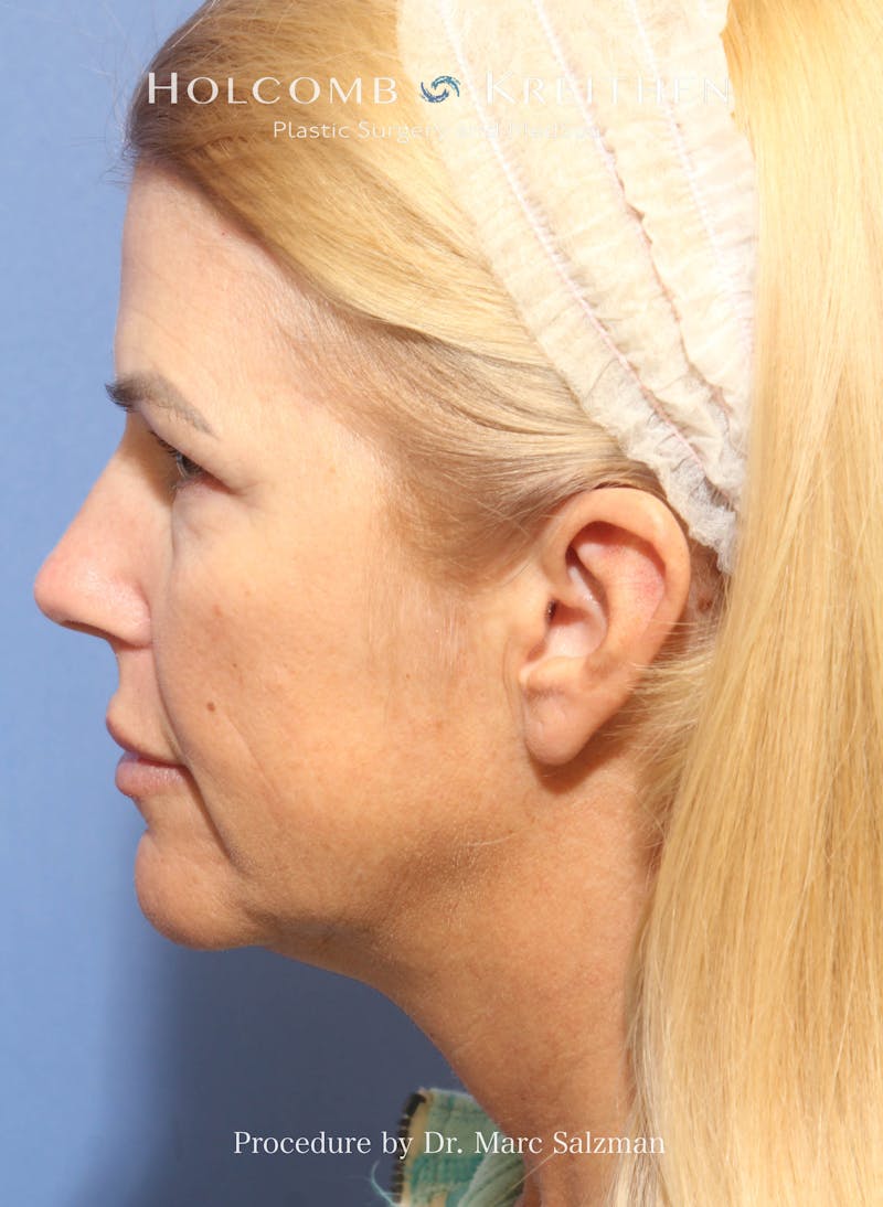 Facelift Before & After Gallery - Patient 354258 - Image 3
