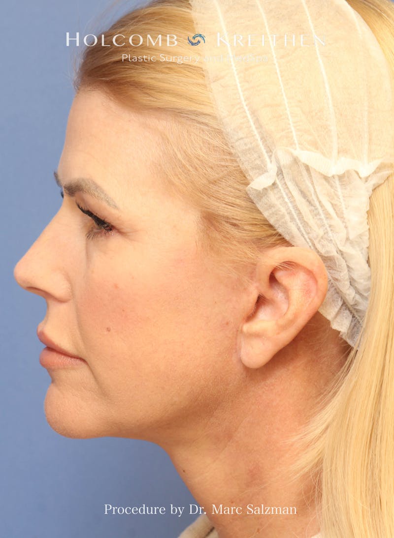 Facelift Before & After Gallery - Patient 354258 - Image 4