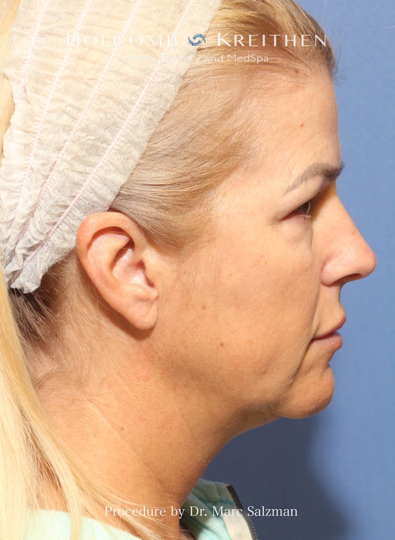 Facelift Before & After Gallery - Patient 354258 - Image 5