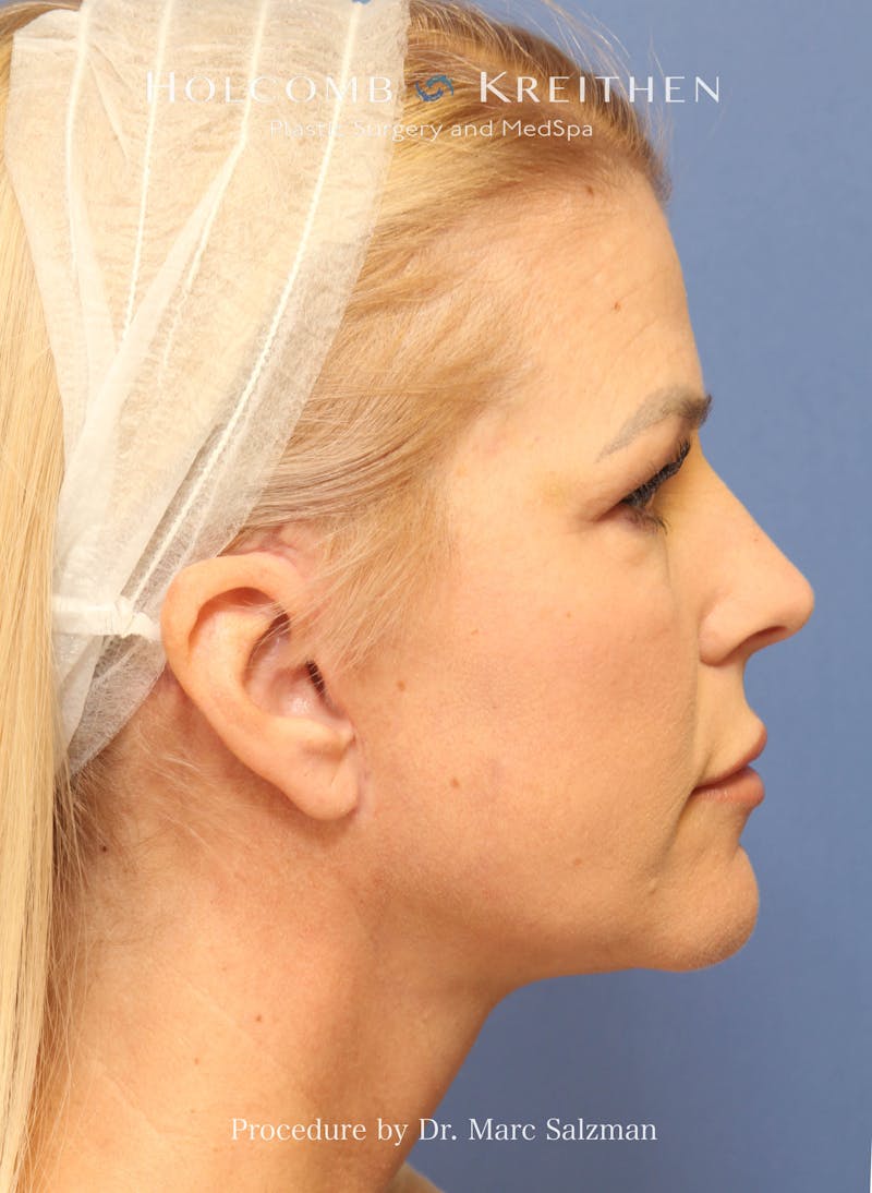Facelift Before & After Gallery - Patient 354258 - Image 6