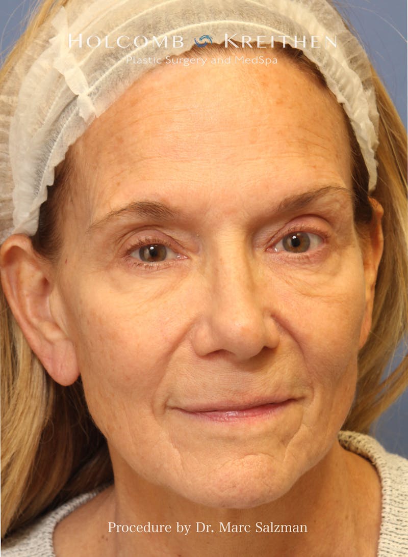 Facelift Before & After Gallery - Patient 739636 - Image 1