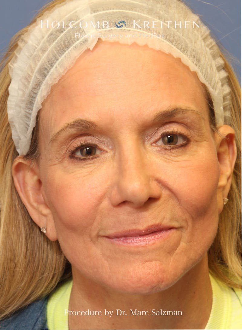 Facelift Before & After Gallery - Patient 739636 - Image 2