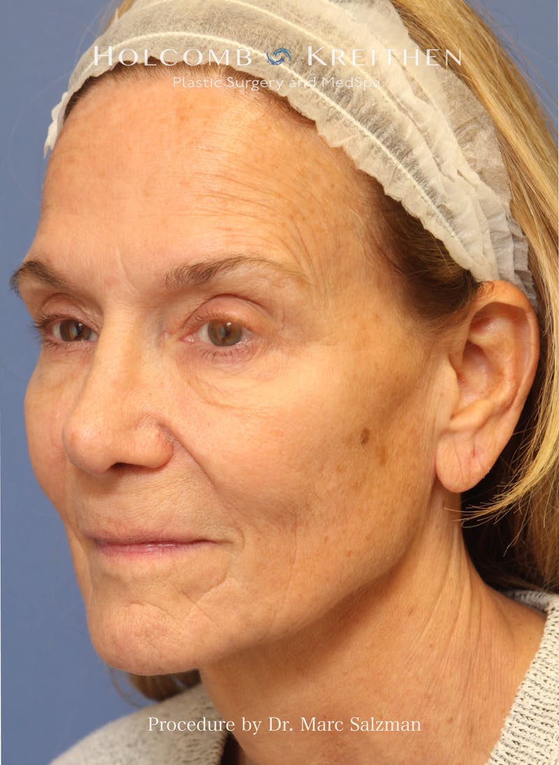 Facelift Before & After Gallery - Patient 739636 - Image 3