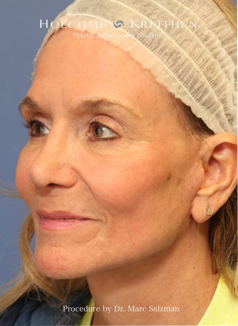 Facelift Before & After Gallery - Patient 739636 - Image 4