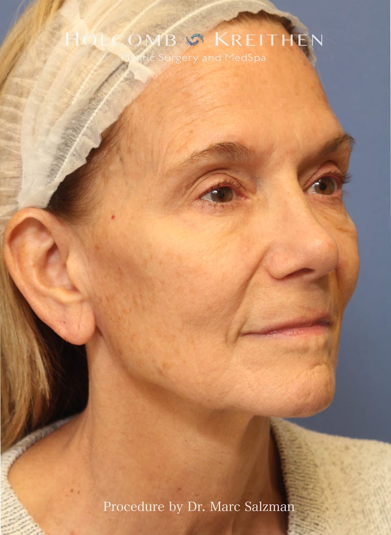Facelift Before & After Gallery - Patient 739636 - Image 5