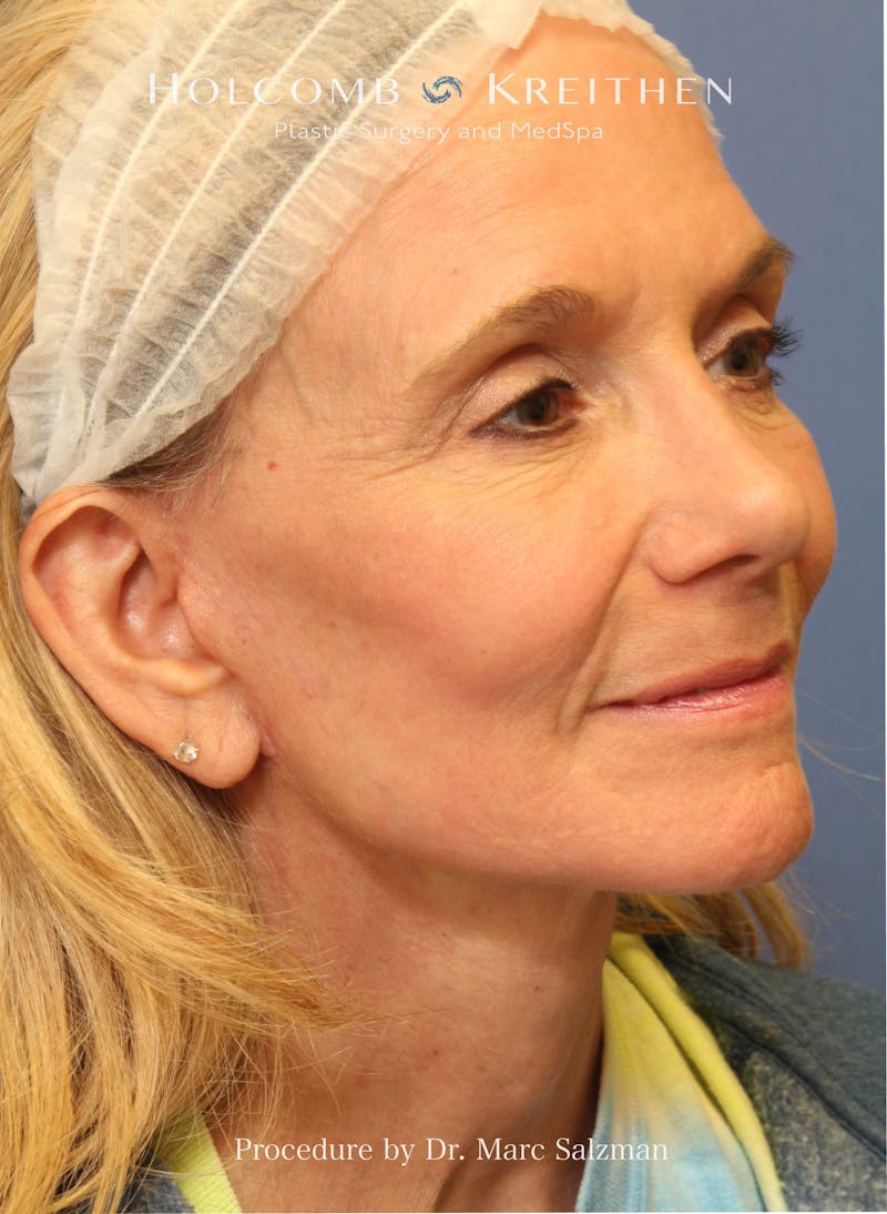 Facelift Before & After Gallery - Patient 739636 - Image 6