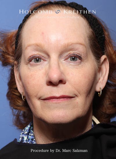 Facelift Before & After Gallery - Patient 176165 - Image 1