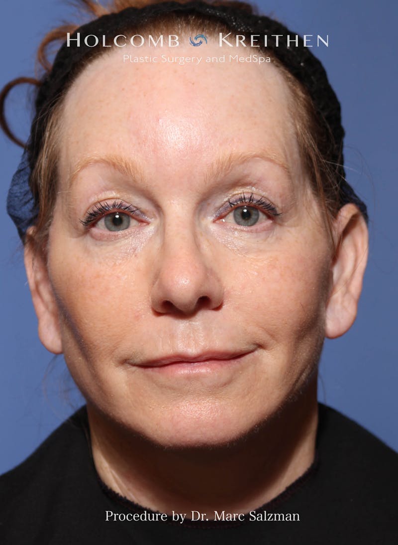 Facelift Before & After Gallery - Patient 176165 - Image 2