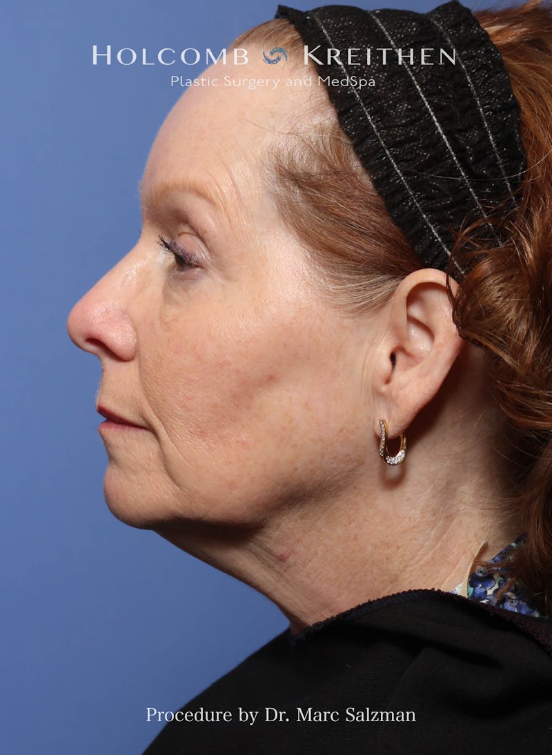 Facelift Before & After Gallery - Patient 176165 - Image 3
