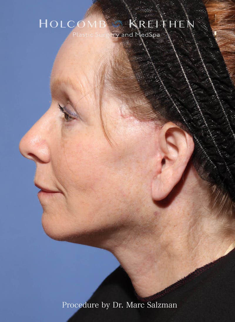 Facelift Before & After Gallery - Patient 176165 - Image 4