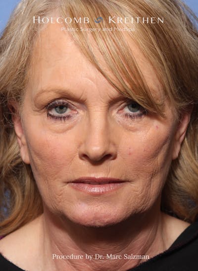 Facelift Before & After Gallery - Patient 338982 - Image 1