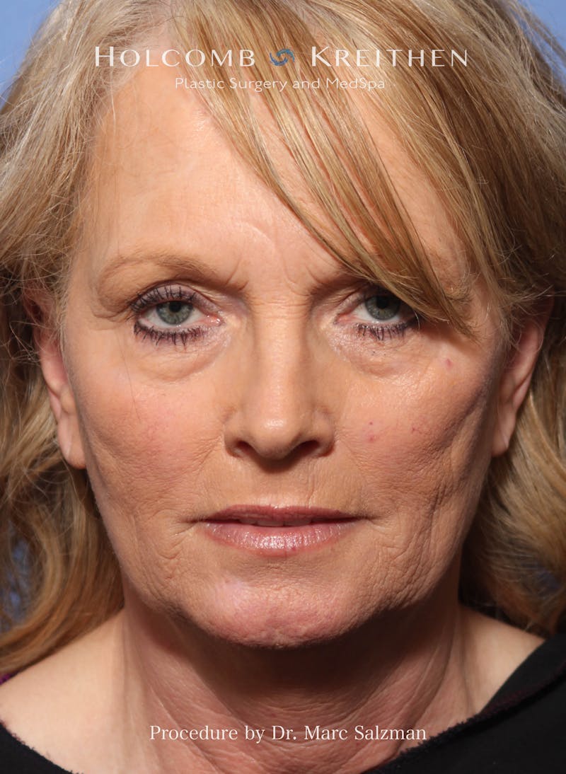Facelift Before & After Gallery - Patient 338982 - Image 1