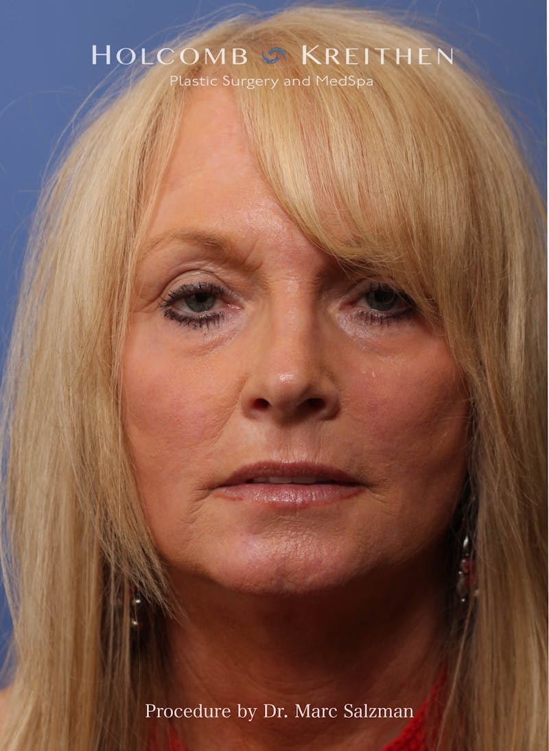 Facelift Before & After Gallery - Patient 338982 - Image 2