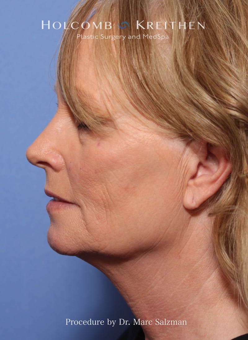 Facelift Before & After Gallery - Patient 338982 - Image 3