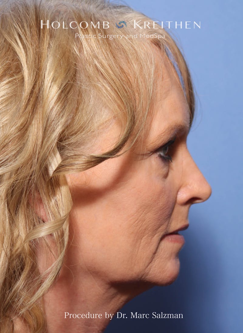 Facelift Before & After Gallery - Patient 338982 - Image 5