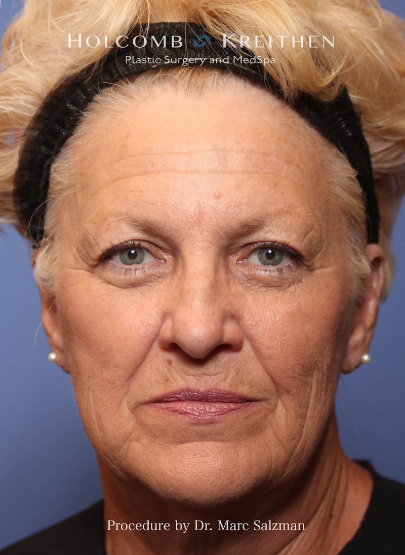 Facelift Before & After Gallery - Patient 277089 - Image 1