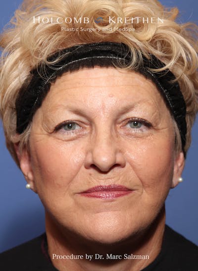 Facelift Before & After Gallery - Patient 277089 - Image 2