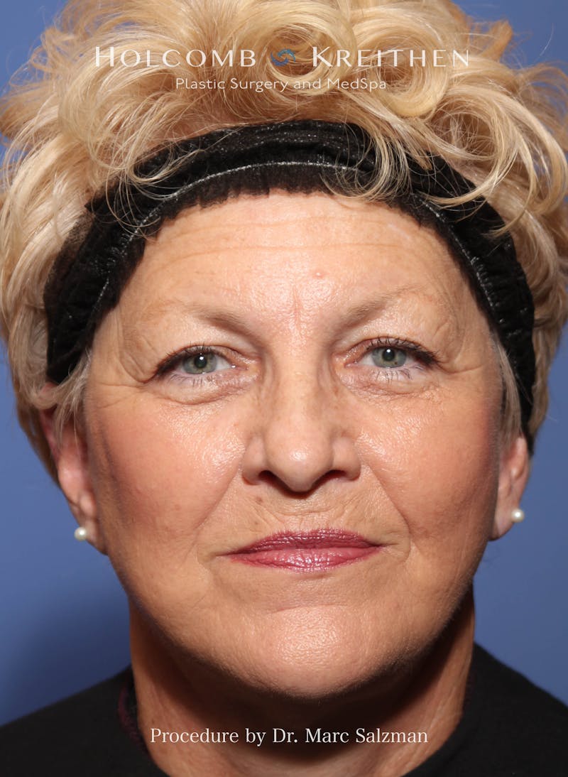 Facelift Before & After Gallery - Patient 277089 - Image 2