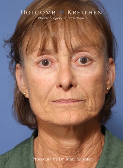 Facelift Before & After Gallery - Patient 212635 - Image 1