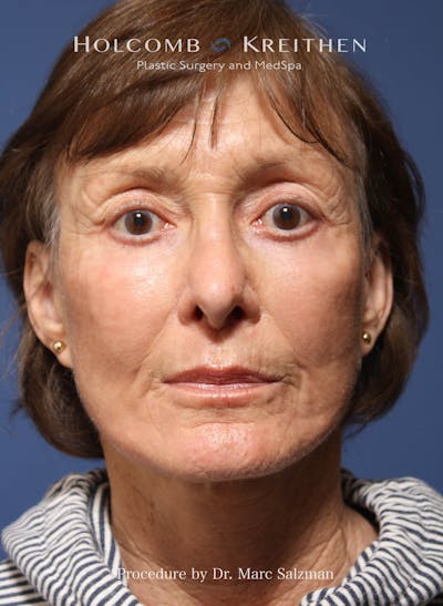 Facelift Before & After Gallery - Patient 212635 - Image 2