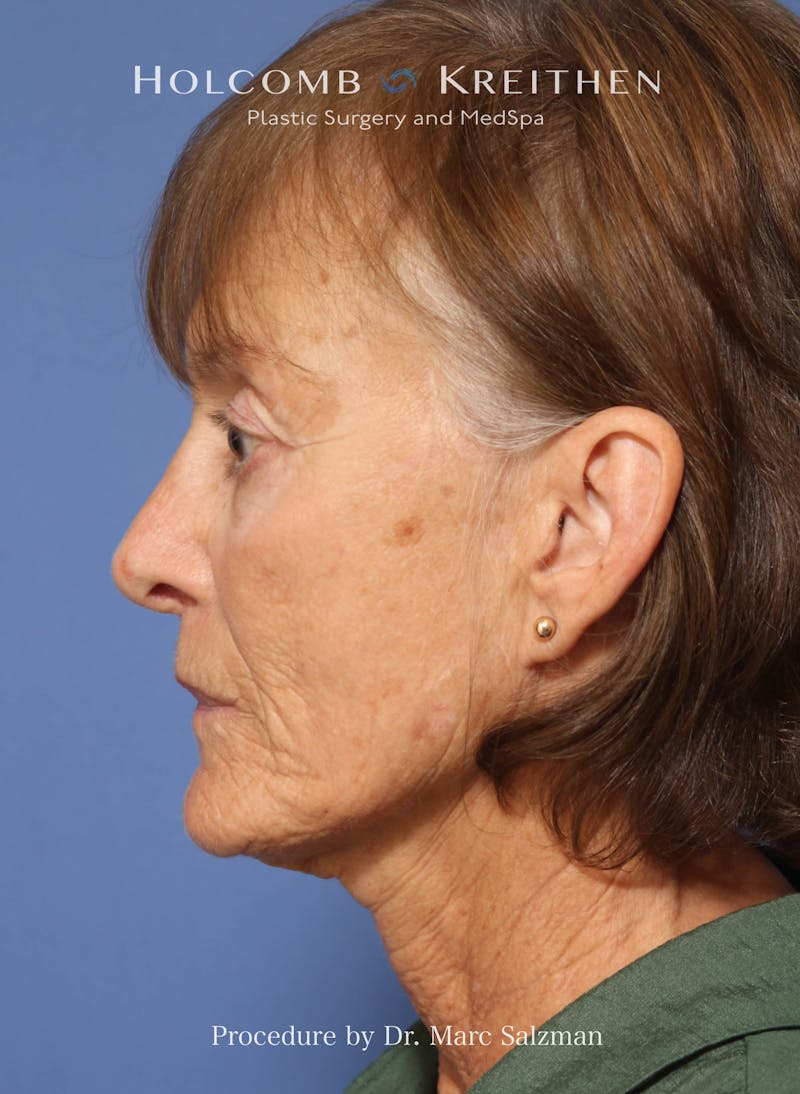 Facelift Before & After Gallery - Patient 212635 - Image 3