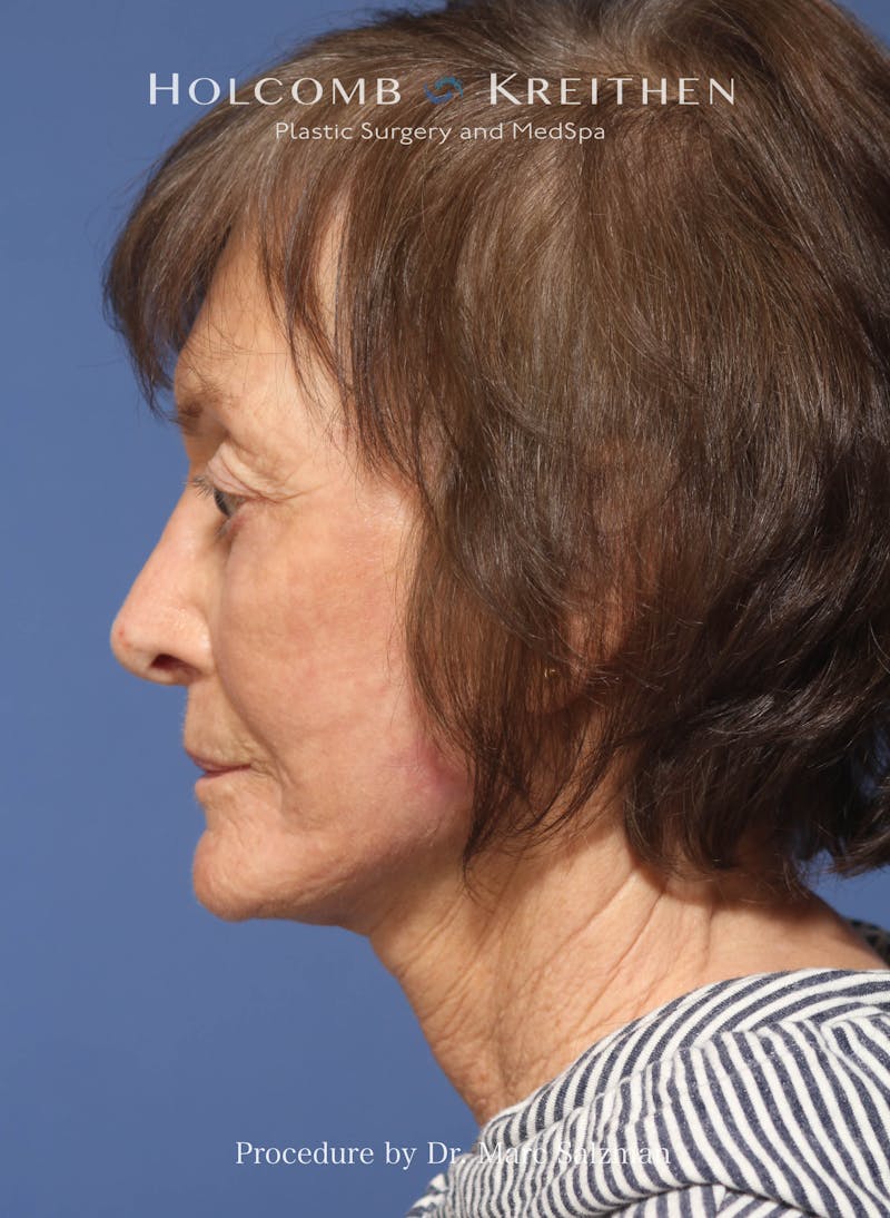 Facelift Before & After Gallery - Patient 212635 - Image 4