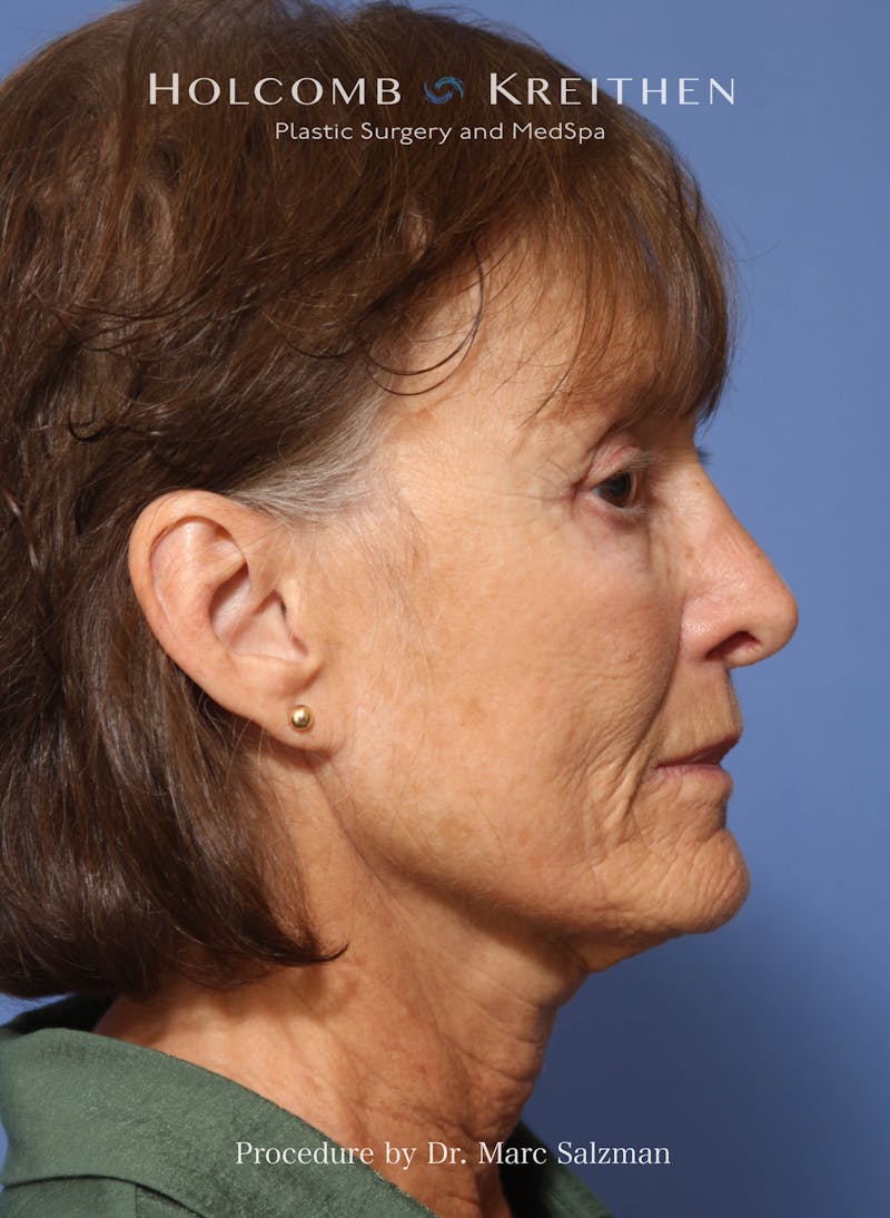 Facelift Before & After Gallery - Patient 212635 - Image 5